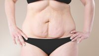 Purisaki Berberine Patches: 14-Day Results You Won’t Believe